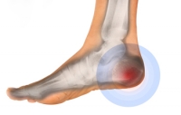 A Common Reason to Have Heel Pain