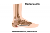 Plantar Fasciitis and Toe Extensions